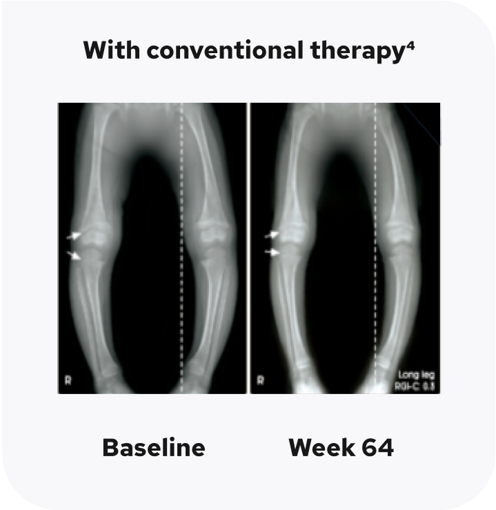 A set of X-ray images of a child's legs showing lack of lower extremity abnormality improvement from baseline to week 64 with conventional therapy