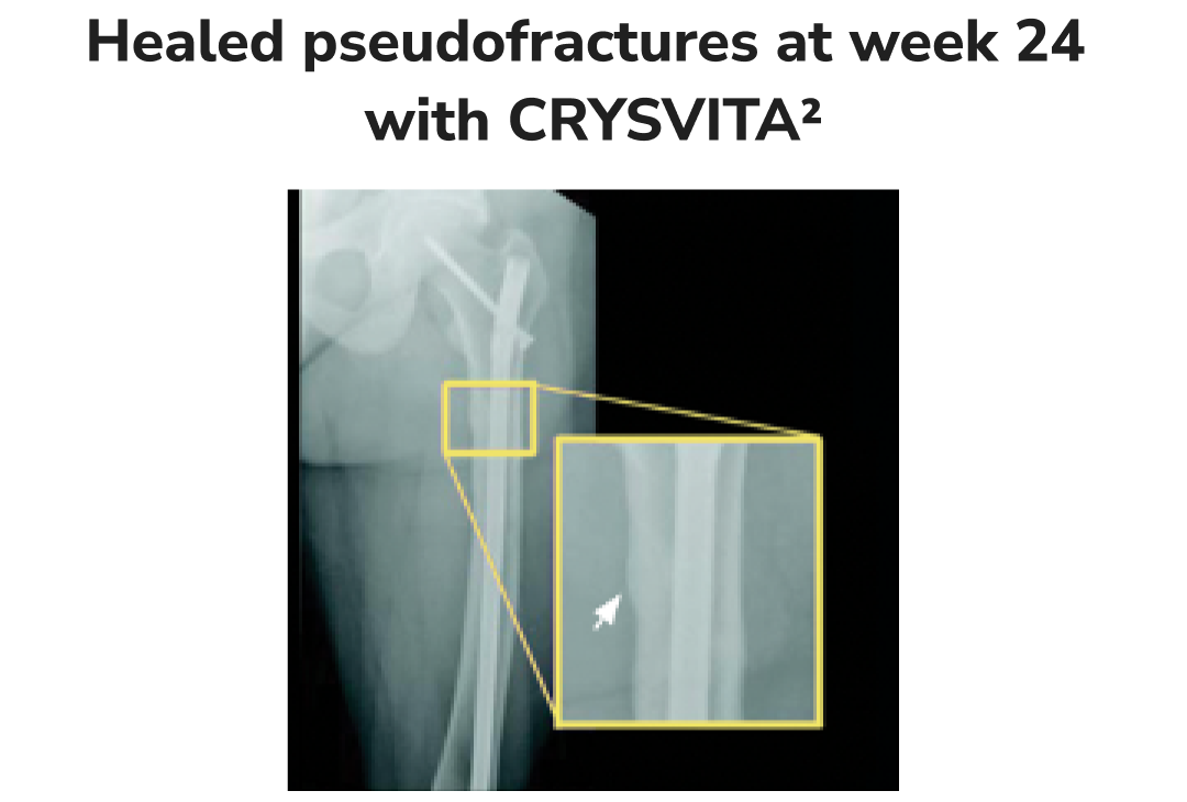 X-ray of a femur bone showing a healed pseudofracture at week 24 with CRYSVITA